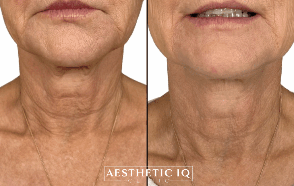 A close up of a woman's neck before and after Radiesse neck treatment at Aesthetic IQ in Scottsdale.