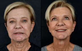 A before and after image of a woman who received Radiesse neck treatment at Aesthetics IQ.