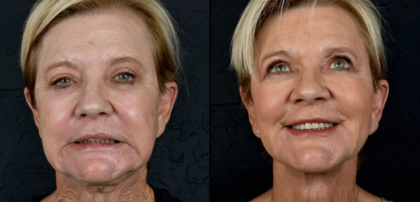 A before and after image of a woman who received Radiesse neck treatment at Aesthetics IQ.